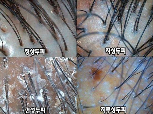 시판 탄산 파우더와 탄산수를 사서 홈케어하는 '헤어 디톡스' 