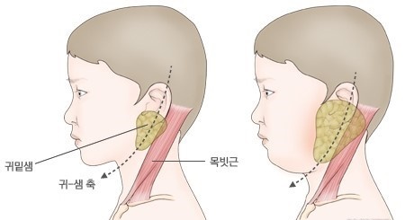 볼거리에서의 특징적인 이하선의 종창./자료=네이버