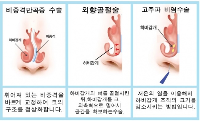 비염수술 대표적 3가지 수술방법/자료=지앤지병원 블로그