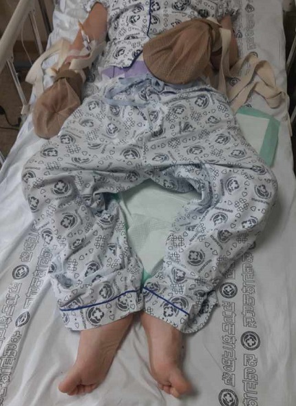 뇌손상에 의한 인지 장애로 안전을 위해 장갑을 낀 채 누워 있는 김진해 씨 ⓢ가족 제공